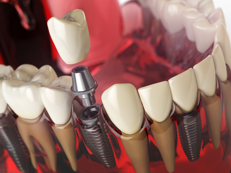 Трохи корисної інформації про зубну імплантацію