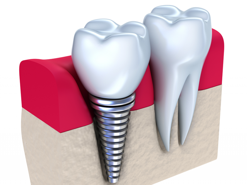 Трохи корисної інформації про зубну імплантацію